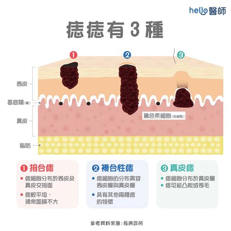 手指 長痣|痣形成的原因？痣長毛、痣變多變大是痣病變？5招判。